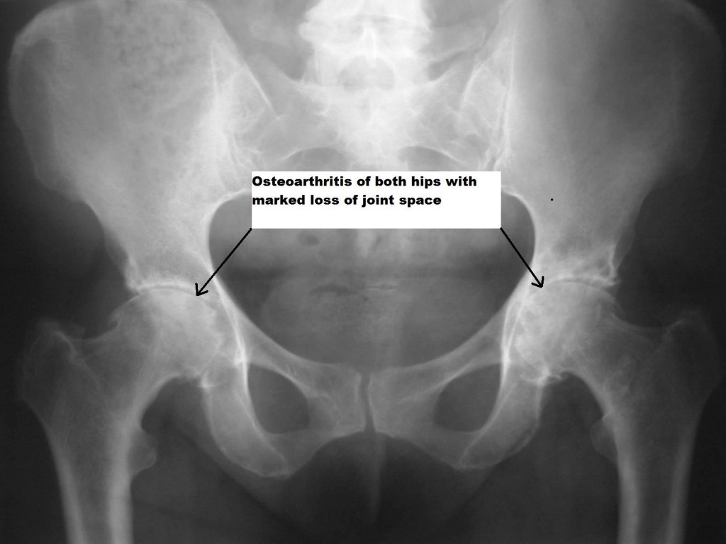 Osteoarthritis of the Hip – Cardiff Hip Replacement