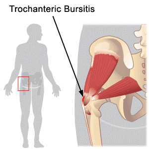 Trochanteric-Bursitis-1