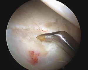 chondral injury to the hip joint