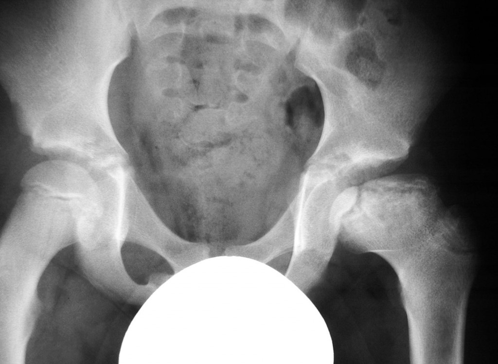 Perthes Disease Cardiff Hip Replacement